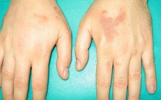 El eklemlerindeki ağrı parazit belirtileri olabilir