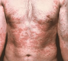 problemli cilt parazitlerin varlığının bir belirtisidir