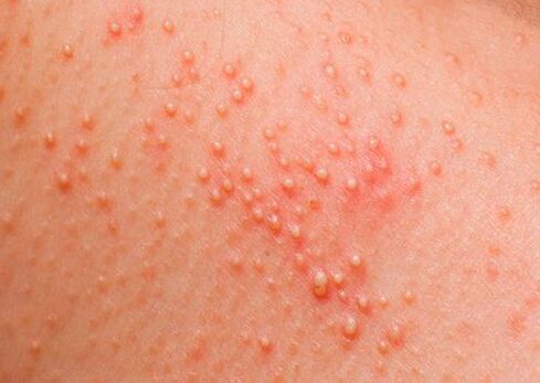 Vücut parazitlerden etkilenirse, cilt alerjisi ortaya çıkar. 